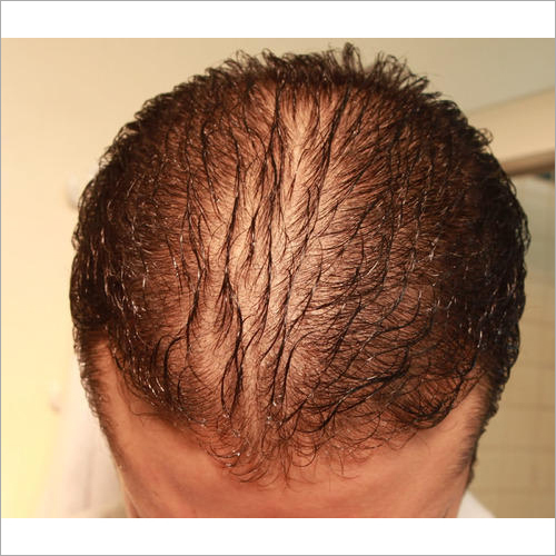 Cell Active Therapy for Hair Regrowth