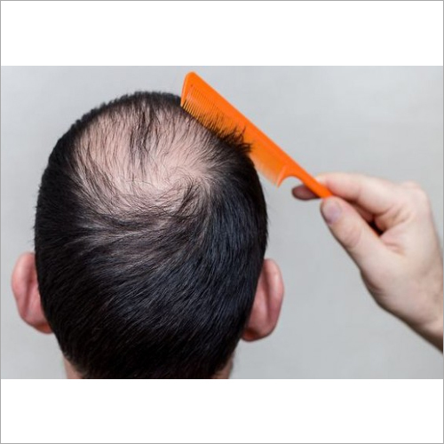Male Hair Loss Treatment