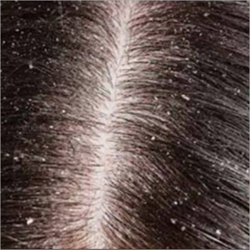 Dandruff Treatment