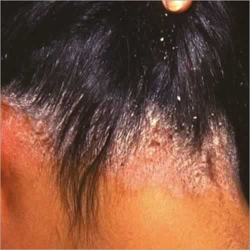 Scalp Peeling Therapy for Dandruff Treatment