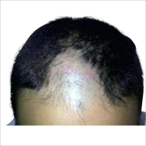 Acupuncture Therapy for Hair Regrowth