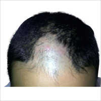 Acupuncture Therapy For Hair Regrowth