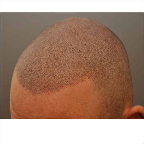 Scalp Micropigmentation