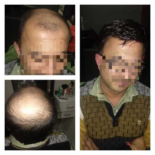 Hair Patch Services in Bhajanpura (Shahdara), Delhi - Madheads Online Llp