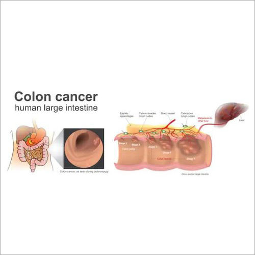 Colon Cancer Natural Herbal Treatment Services Without Side Effects By NUTRIIHEALTH WELLNESS FOUNDATION