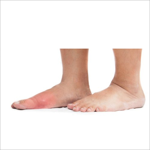 Gout Ayurvedic Treatment By AADHAR AYURVED AND PANCHKARM CENTRE
