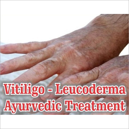 Leucoderma Ayurvedic Treatment
