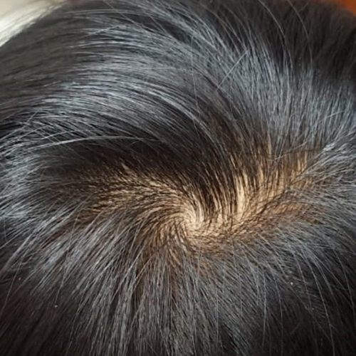 Mirage Mens Hair Patch at Best Price in Pune | Tips And Tops Hair Solutions