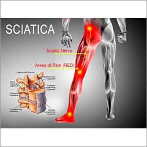 Sciatica Treatment Services