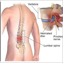 Slip Disc Treatment Services
