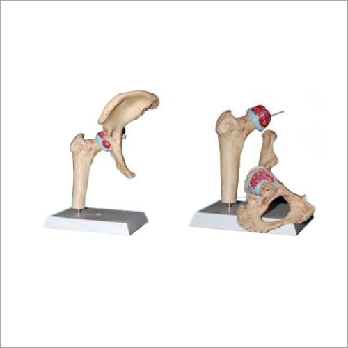 HIP Osteoarthritis