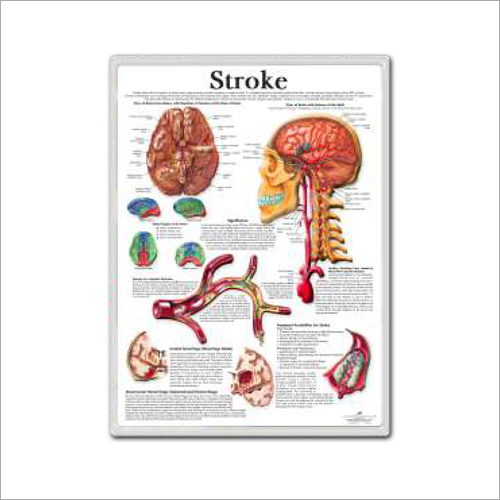 Stroke 3d Anatomical Charts