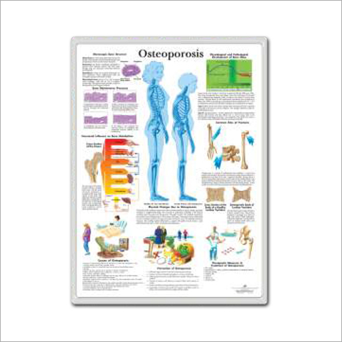 Osteoporosis 3D Anatomical Charts - Paper/Laminate, 24x36 Inches, White | Detailed Anatomy, 3D Visualization, Educational Tool