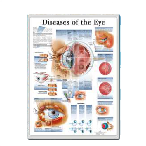 Diseases of the Eye 3d Anatomical Charts