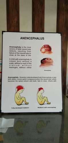 Chart of Anencephalus