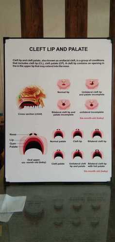 Chart of Cleft Lip and Palate