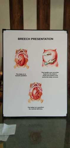 Chart of Breech Presentation