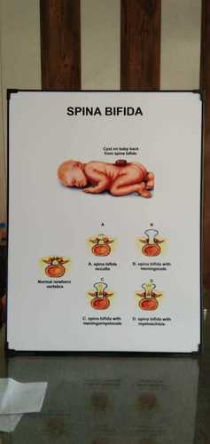 Chart of Spina Bifida