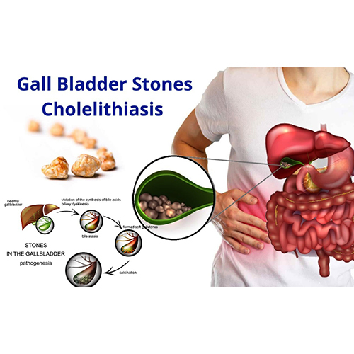 Ayush Cure For  Gallbladder Stone