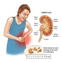 Ayush Cure For Kidney Stone