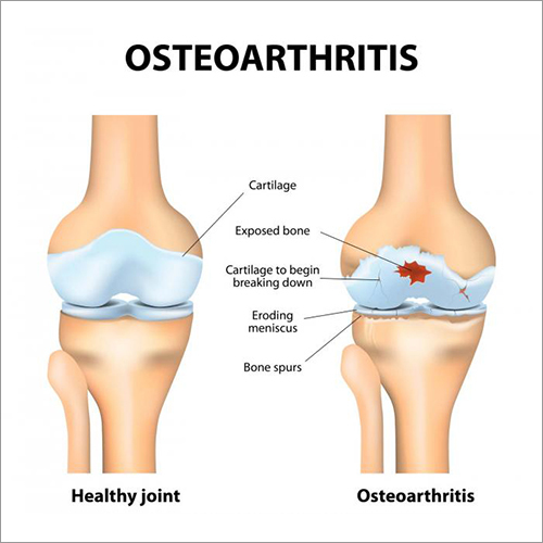 Ayush Cure For Osteoarthritis Problems