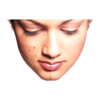 Ayush Cure For Pimple And Black Spot