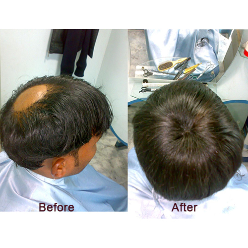 Hair Transplant at Best Price in Bhopal, Madhya Pradesh | Neeta Enterprises
