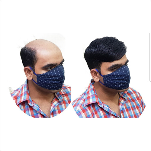 Hair Replacement In Delhi