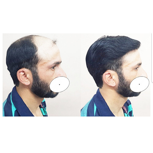 Best Hair Patch in Delhi by Realhair house1 - Issuu