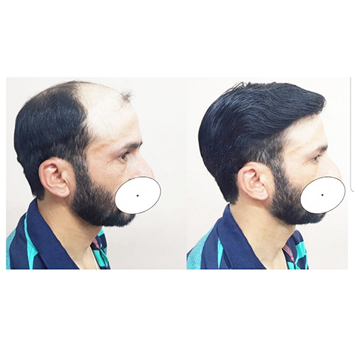 Hair Wigs Manufacturer In Delhi