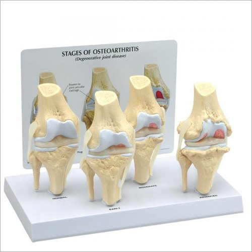 4 Stage Knee Arthritis Model