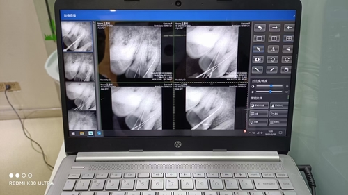 Photon counting Technology Dental X-ray Sensor model  Made in China