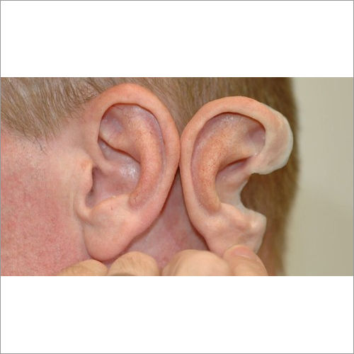 Silicone Ear Prosthesis