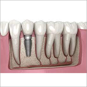 Dental Implants Kit