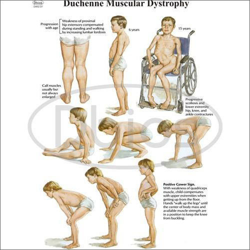 Duchenne Muscular Dystrophy Chart