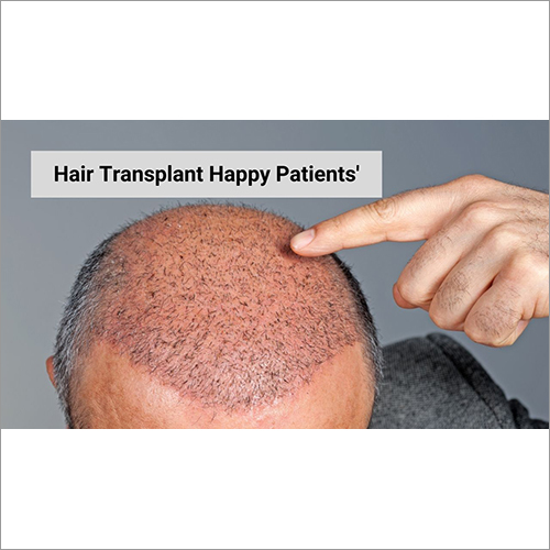 Surgery Hair Transplantation Treatment Services