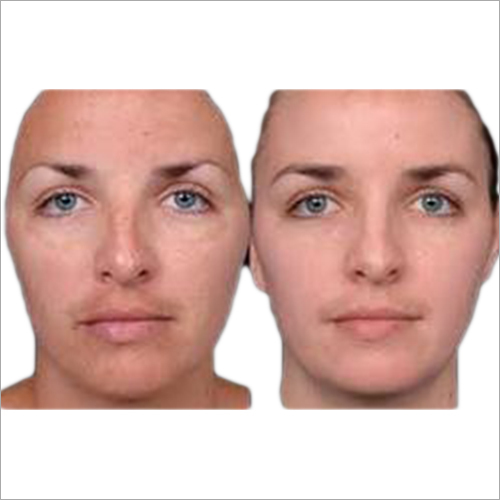 Yellow Skin Peels