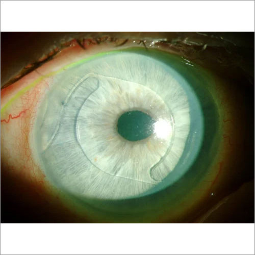 Pmma Chamber Anterior Lens