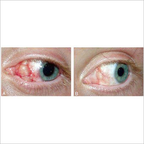 Conjunctival or Ocular Surface Surgeries By Maskati Eye Clinic