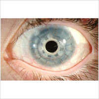 Corneal Surgeries