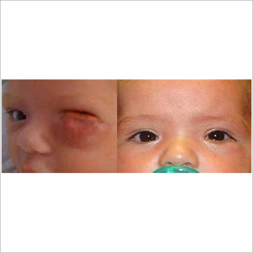 Paediatric And Oculoplastic Eye Surgeries