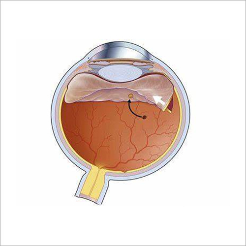 Vitreo Retinal Procedures