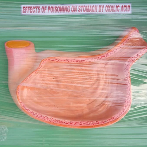 Effects Of Poisoning On Stomach Model By Oxalic Anatomic Model Acid