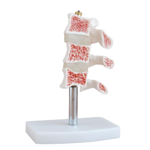 White-Red Cutaway Osteoporosis Model