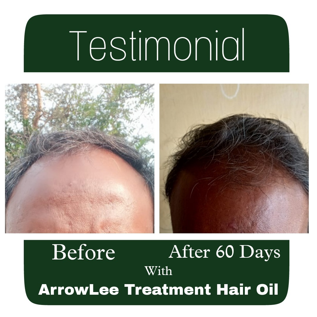 Natural Tratment Hair Oil For All Types Of Hair Problem