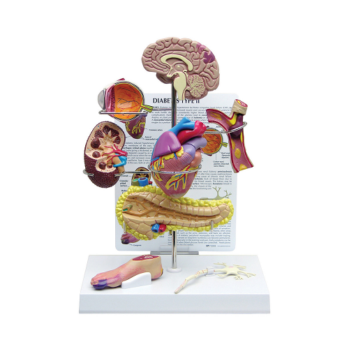 SI/AN 545 The Model Of Diabetes