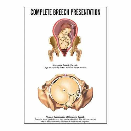 INC06 Complete Breech Presentation