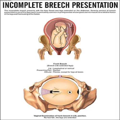 INC07 Incomplete Breech Presentation