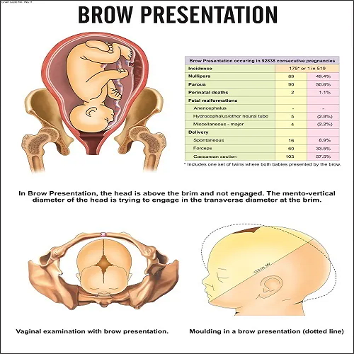 INC11 Brow Presentation