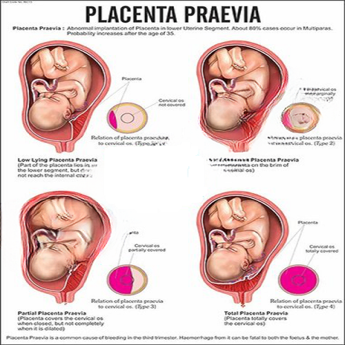 INC13 Placenta Praevia